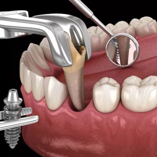 آیا بلافاصله بعد از کشیدن دندان می‌توان ایمپلنت کرد؟